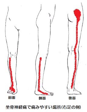坐骨神経痛による足のしびれのイメージ