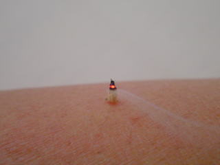 米粒よりも小さくひねる灸