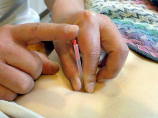 東洋医学の治療5