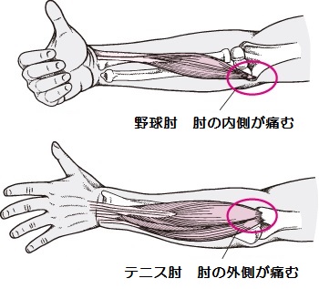 テニス肘、野球肘