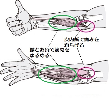 テニス肘、野球肘