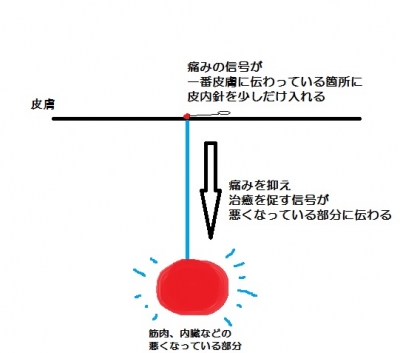 皮内針が効く理由2