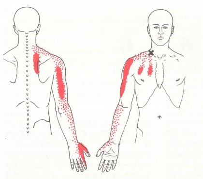 腕のシビレ、頚肩腕症候群、頚椎症