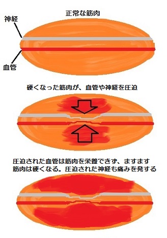 筋肉のコリ　さいたま市大宮区の北田鍼灸院