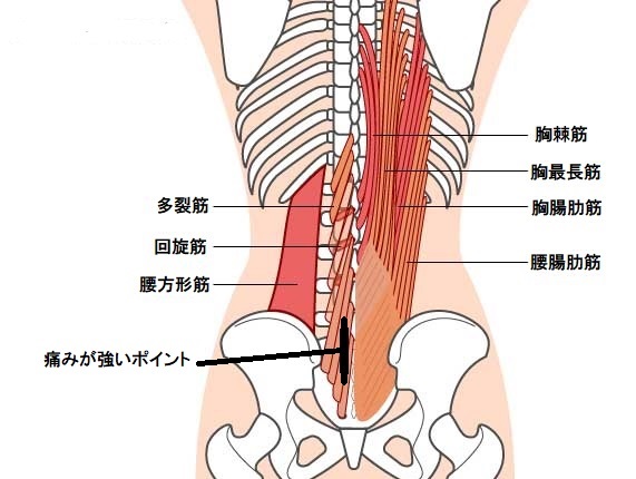 腰痛　ギックリ腰の後、1年くらい痛くない日が無い