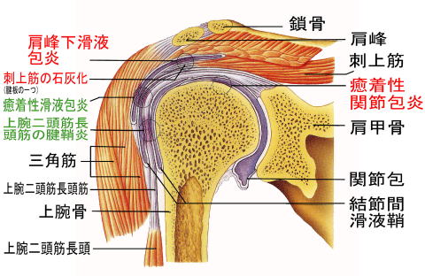 石灰沈着性腱板炎