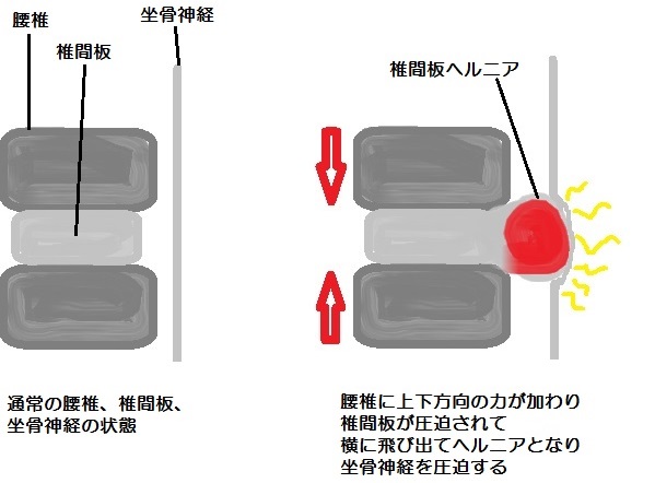 椎間板ヘルニア